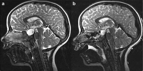 Pre A And Postoperative B Mri Sagittal T Weighted Images Of The