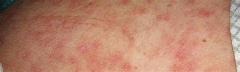 Skin Rash And Sexually Transmitted Diseases Symptoms 43 Off