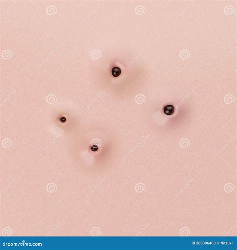 Grade Of Acne Severity Medical Diagram Different Types Acne