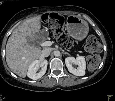 Candidiasis Liver Ultrasound