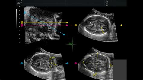 Sonocns Nd Rd Trimester Ultrasound Voluson Ultrasound