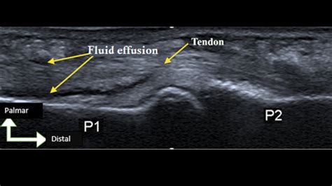 Flexor Tenosynovitis Internet Book Of Msk Ultrasound