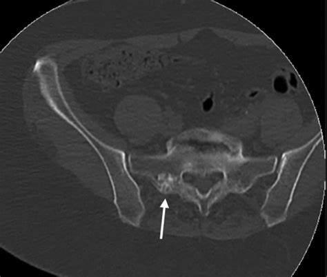 Axial CT Image Obtained During Percutaneous Biopsy Demonstrating A