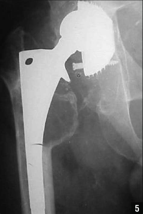 Preoperative Anteroposterior Radiograph Of The Right Hip Demonstrating Download Scientific