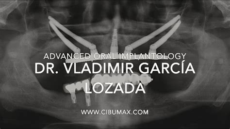 Implantes Zigomáticos Dr Vladimir García Lozada Zygoma Implants