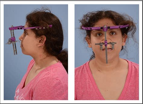 Interdisciplinary Approach For The Treatment Of Complex Bilateral Cleft Lip And Palate With