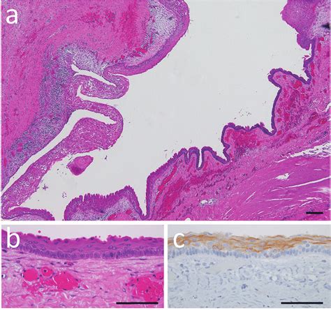 Histological Findings A The Cyst Wall Is Lined With Layers Of