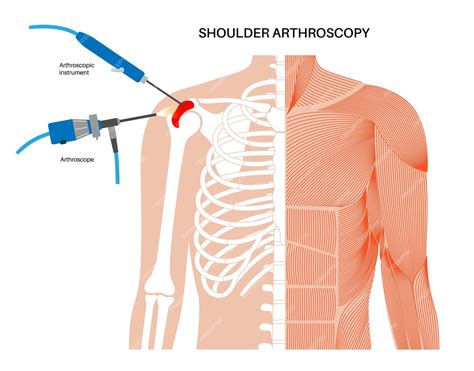 Premium Vector Shoulder Arthroscopy Procedure Rotator Cuff Tears Shoulder Muscles Problem