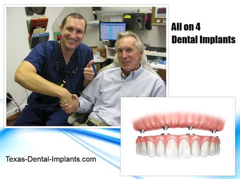 All On 4 Four Dental Implants Pasadena Texas Implant Denture