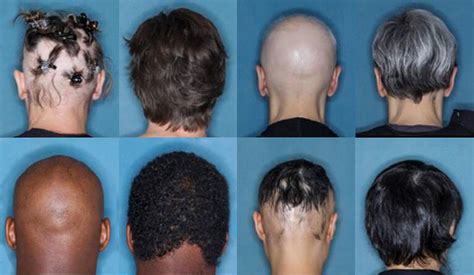 Trial Shows Arthritis Drug Restores Hair In A Third Of Alopecia Patients