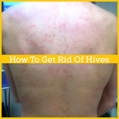 How To Get Rid Of Hives Permanently 633