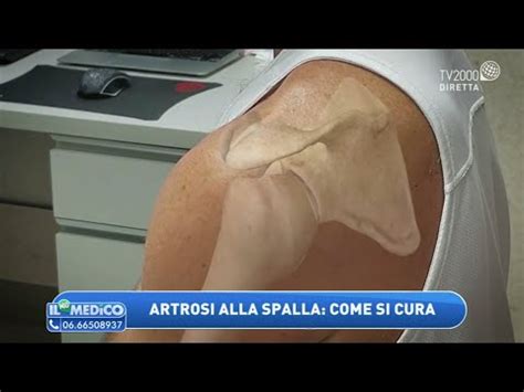 Artrosi Alla Spalla Come Si Cura Il Mio Medico