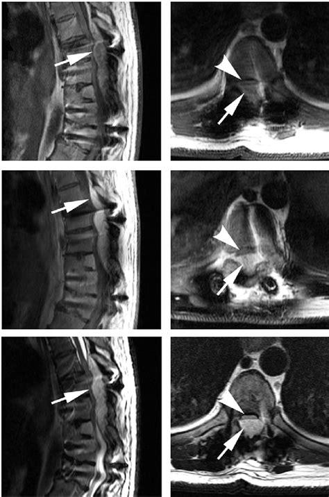 Mri Of The Thoracic Area Showing An Epidural Mass At The Levels Of