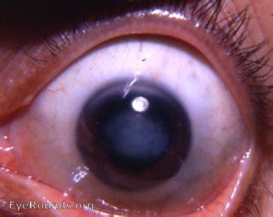 Syphilis: congenital interstitial keratitis. EyeRounds.org: Online Ophthalmic Atlas