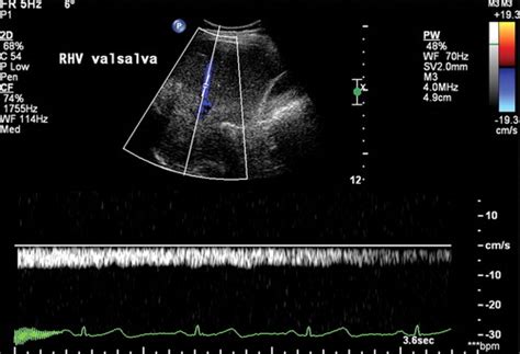 Understanding The Spectral Doppler Waveform Of The Hepatic Veins In