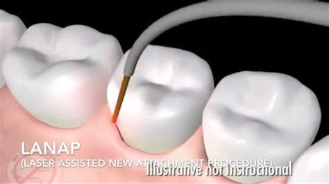 How Does Laser Surgery Work Treat Gum Disease Lanap Youtube