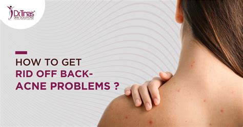 Say Goodbye To Back Acne Scars Effective Strategies For Treatment Skin Solutionz