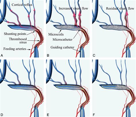 Figure 1 From Arteriovenous Fistulas Effective Transvenous Embolization