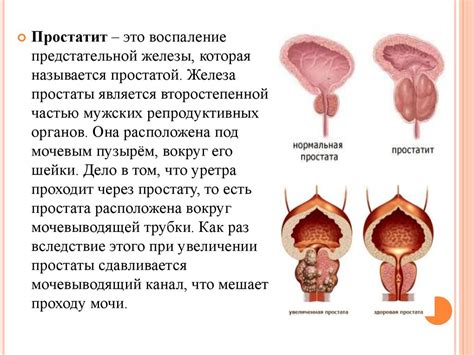 Простатит. Факторы, способствующие развитию простатита - презентация онлайн