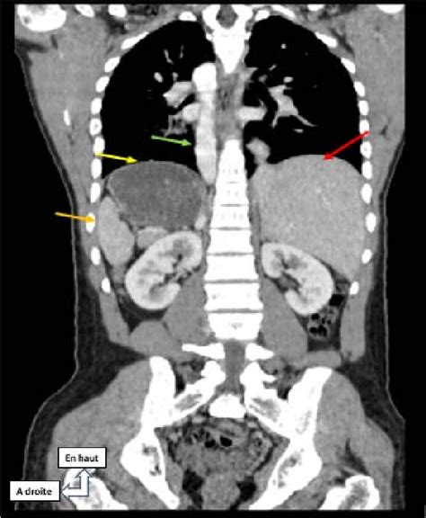 Tomodensitom Trie Tdm Thoracoabdomino Pelvienne En Coupe Coronale On