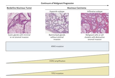 Mucinous Ovarian Carcinoma New England Journal Of Medicine