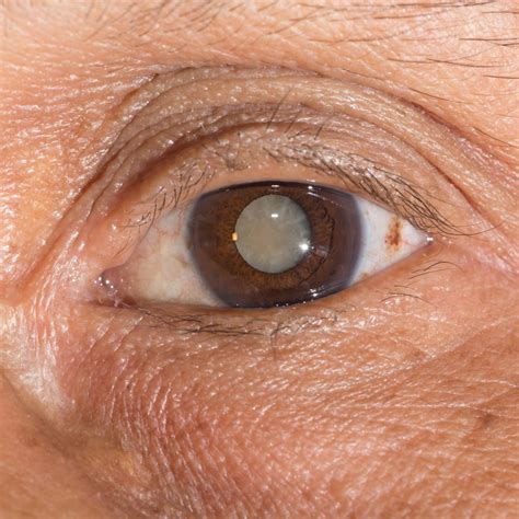 Wat Is Cataract Oorzaak Symptomen Dr Carl Verdonck