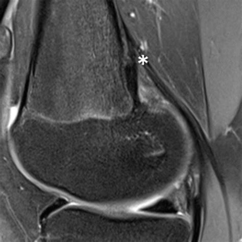 Distal Femoral Cortical Irregularity At Knee Mri Increased Prevalence