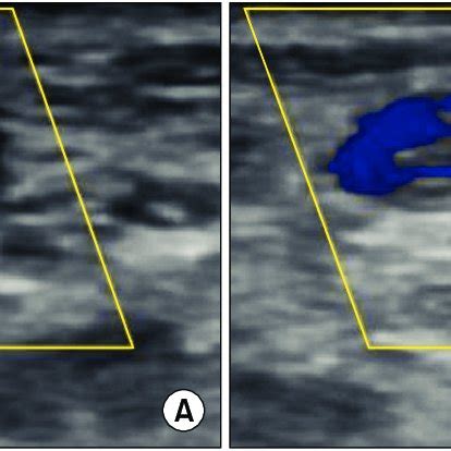 Ultrasonographic Findings Of Upper Extremity Deep Vein Thrombosis