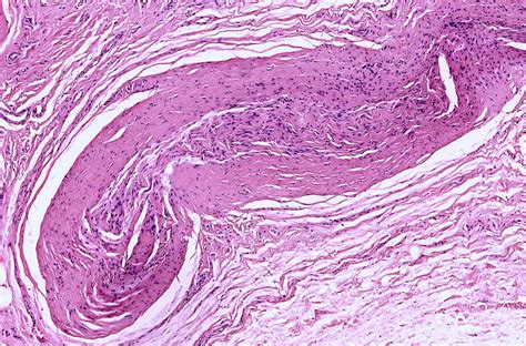 Traumatic Neuroma Pathology Outlines