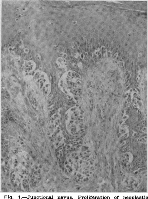 Figure 1 from Histopathology of malignant melanomas and certain benign ...