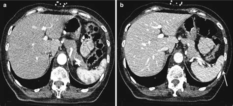 Splenic Injuries Radiology Key