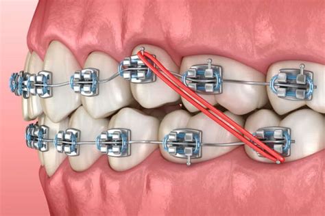 Gomas De Brackets Para Qu Sirven En Ortodoncia