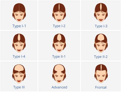 Female Pattern Hair Loss