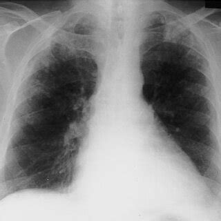 A Posteroanterior Chest Radiograph Showing Multiple Ill Defined