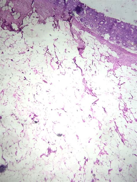 Low Power View Of Histopathological Examination Of Specimen Showing Download Scientific Diagram