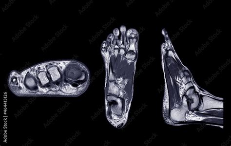 Manetic Resonance Imaging Of Foot Or MRI FOOT PDW Axial Coronal And