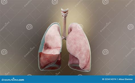 D Illustration Of Hemopneumothorax Normal Lung Versus Collapsed