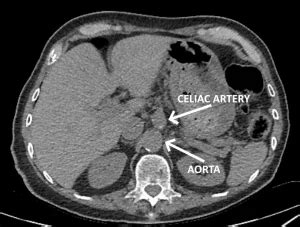 Celiac Artery Aneurysm: Surveillance, Indications for Intervention