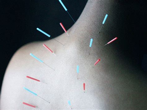 Acupuncture For Neck Pain Does It Work