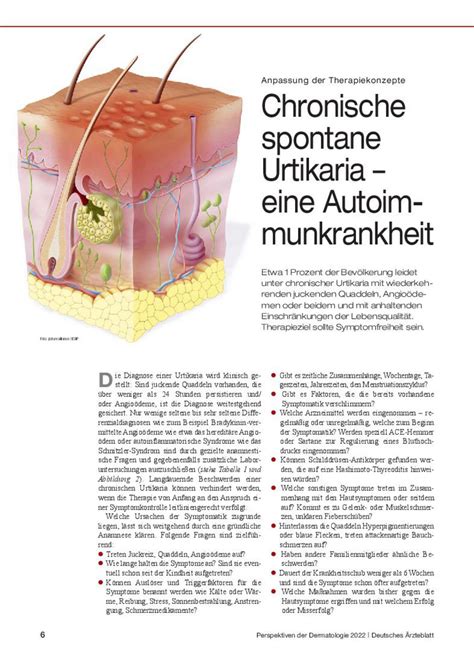 Anpassung Der Therapiekonzepte Chronische Spontane Urtikaria Eine