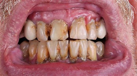 Meth Mouth | Images, Symptoms, & Treatment Options