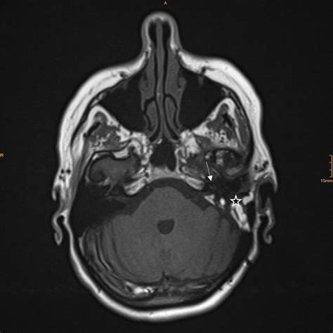 MRI T1, axial, postoperative image. The arrow points at the cochlea ...