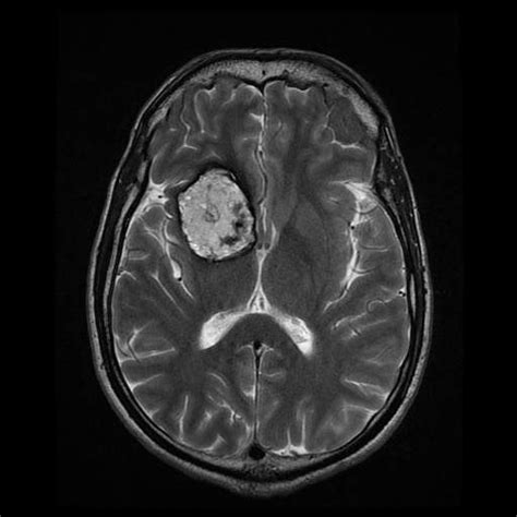 Cerebral Cavernous Malformation Image Radiopaedia Org