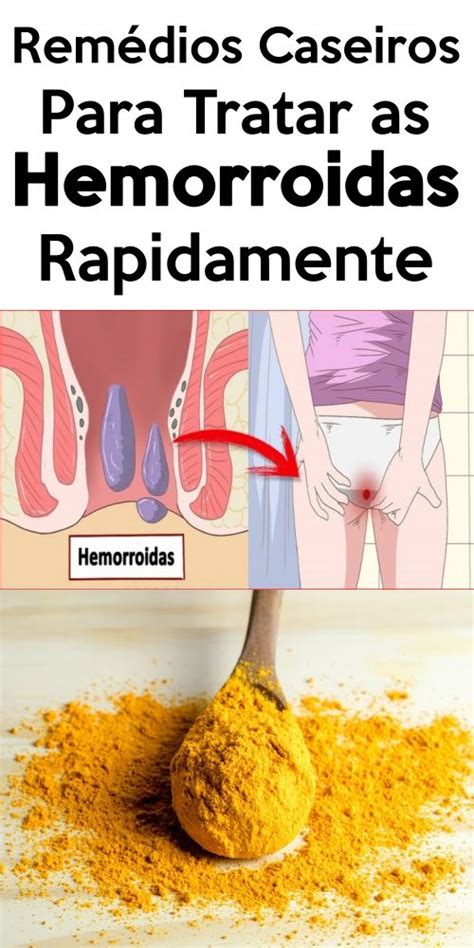 3 Remédios Caseiros Para Tratar As Hemorroidas Rapidamente