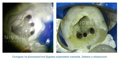 Лікування під мікроскопом