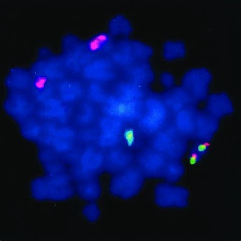 Metaphase Fish With A Pml Probe Red And A Rara Probe Green Showing