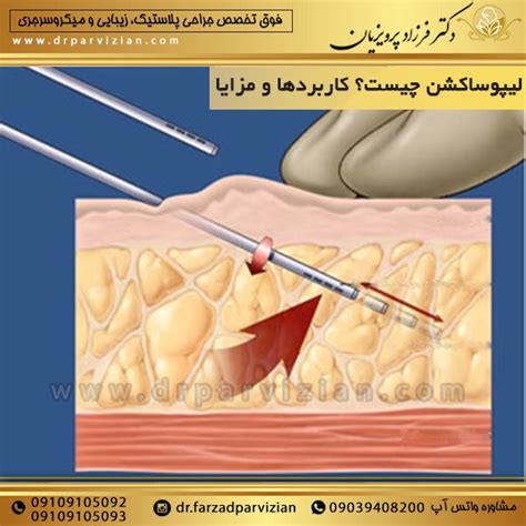 مزایا و معایب لیپوساکشن دکتر فرزاد پرویزیان