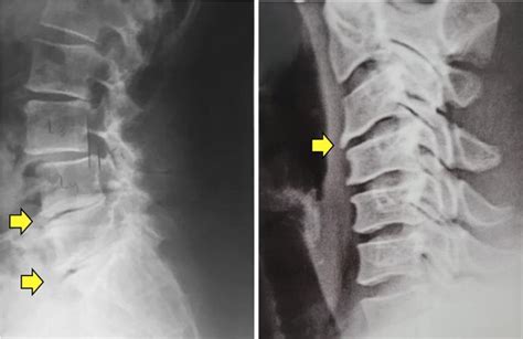 Espondiloartrose Degenera O Da Coluna Vertebral Dr Alberto Gotfryd