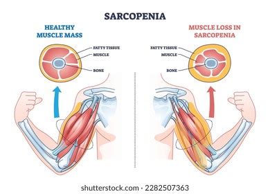 Sarcopenia Muscle Mass Loss Fatty Tissue Stock Vector Royalty Free