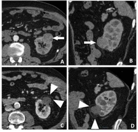 Contrast Enhanced Ct Scan Before Cryoablation With Axial A And Download Scientific Diagram